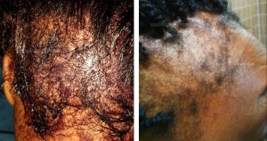Black women suing L'Oreal after product burned their scalps