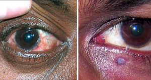 HIV eye symptoms