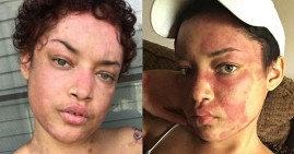 Black woman with lupus