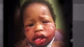 1-year old baby attacked at daycare in Indianapolis
