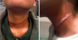 Rope burns a Black girl suffered because of apparent bullying