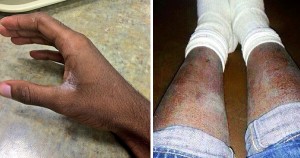 African American with ashy and dry skin