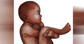 Black fetus