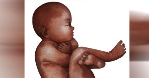 Black fetus