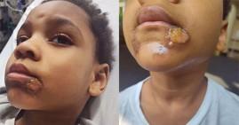 Idris, Black boy burned by school water fountain