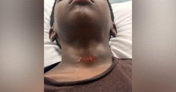 Black Mom Upset After 8-Year-Old Son Suffers Neck Injury on School Playground Black Mom Upset After 8-Year-Old Son Suffers Neck Injury on School Playground