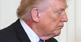 Donald Trump with neck rash