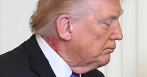 Donald Trump with neck rash