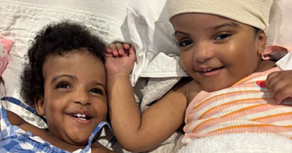 Black Twin Sisters Born Joined at the Head Successfully Separated After Rare Surgery