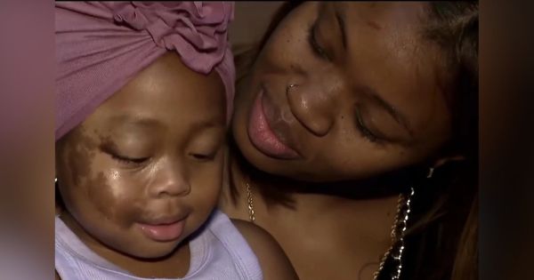 2-Year-Old Black Girl Needed Two Surgeries After Fire Extinguisher Falls on Her Foot at Daycare