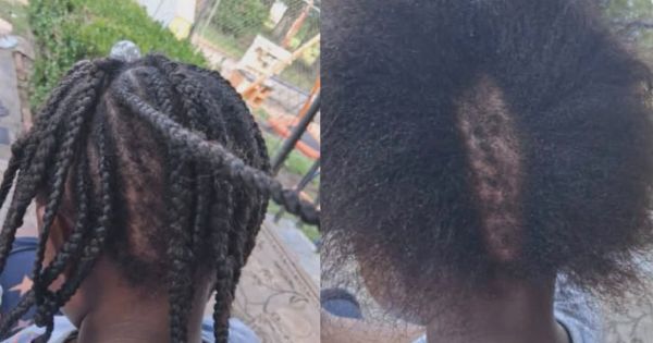 Mother Says Her Black Daughter Left With Bald Spot After Another Student Repeatedly Pulled Her Hair at School